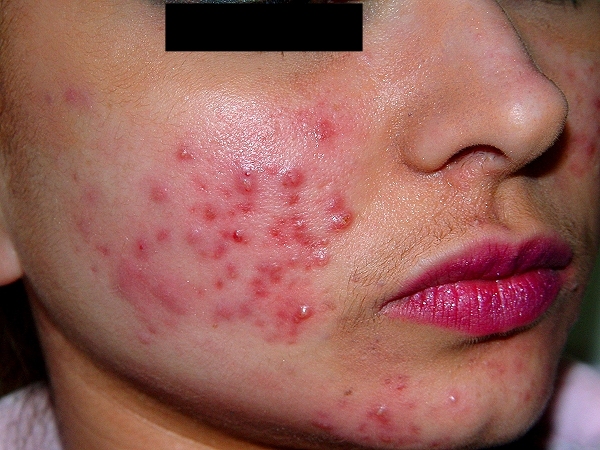 how long does it take for acne scars to fade