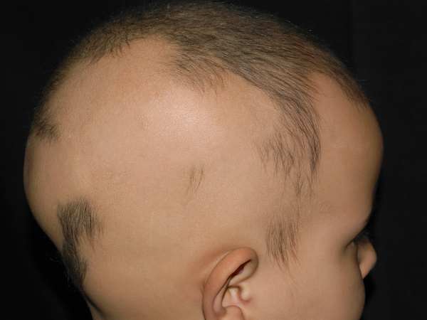 Photos - Alopecia World