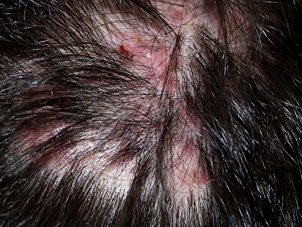 Picture of Folliculitis - WebMD