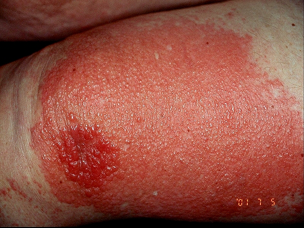 Atopic Dermatitis Picture Image on MedicineNet.com