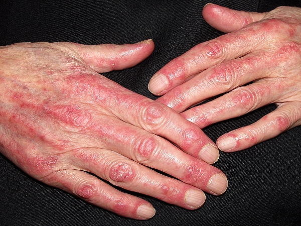 dermatitis on hands #9