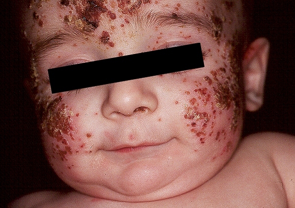 Eczema herpeticum: huidinfectie herpes simplex virus (HSV ...