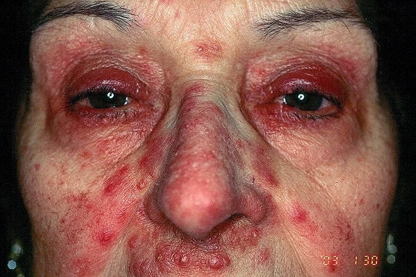 Eyelid dermatitis - Wikipedia