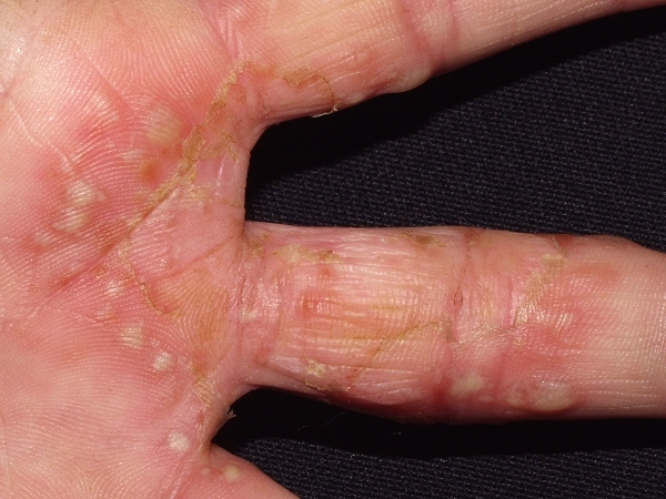 3 Ways to Treat Hand Eczema – wikiHow